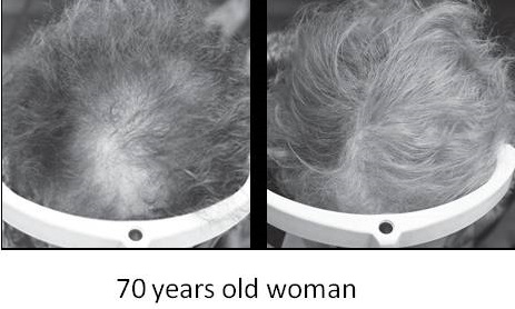 Hair-Loss2-6.jpg
