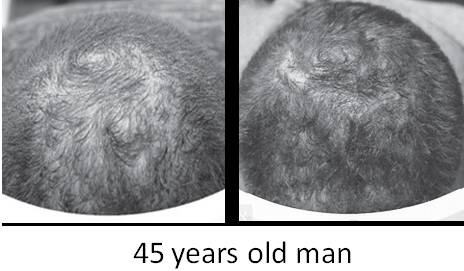 Hair-Loss3.jpg
